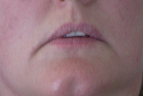   Pernanent Makeup Lip Blend Before