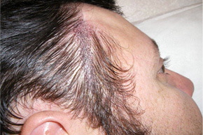  Permanent Scar Camouflage Makeup After