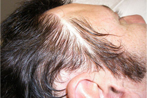  Permanent Scar Camouflage Makeup  Before